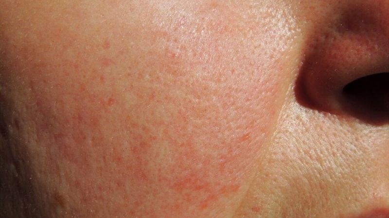 Bạn không nên dùng lại tẩy da chết nếu da nổi mẩn đỏ sau lần sử dụng đầu tiên