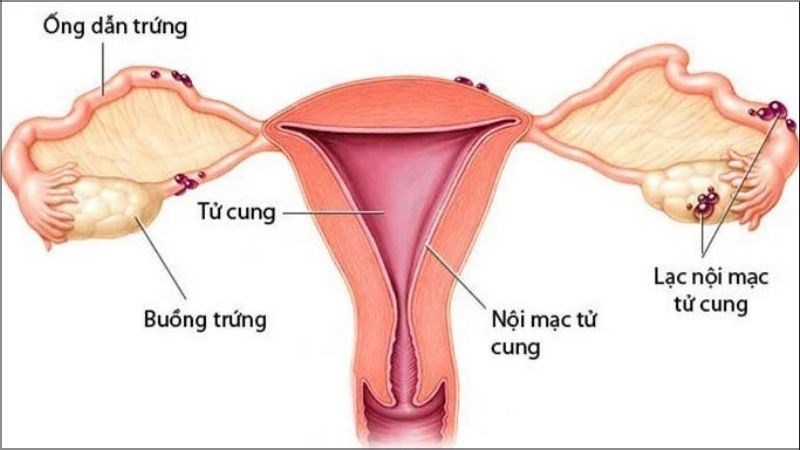 Lạc nội mạc tử cung có thể gây những đau đớn dữ dội ở vùng chậu