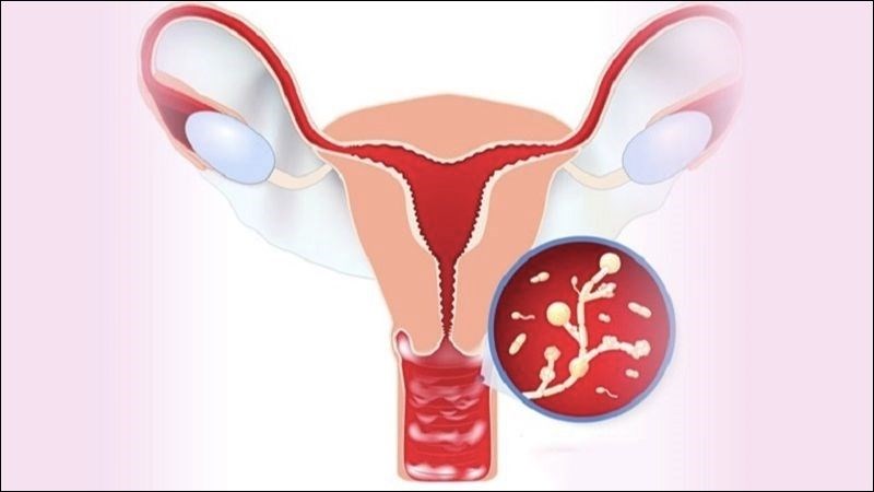 Viêm vùng chậu là một bệnh nhiễm trùng của cơ quan sinh sản nữ