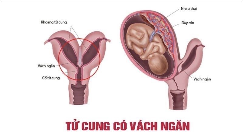 Tử cung có vách ngăn là loại bất thường ở tử cung phổ biến nhất