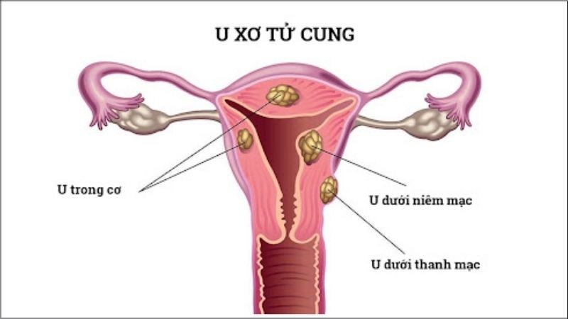 U xơ tử cung là một dạng u lành tính của tử cung