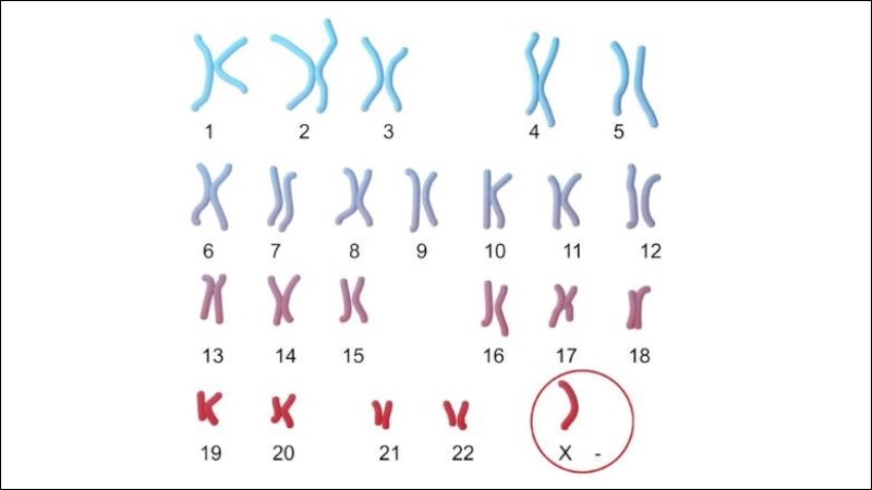 Hội chứng Turner làm bé gái sinh ra với nhiễm sắc thể X bị mất một phần hoặc hoàn toàn