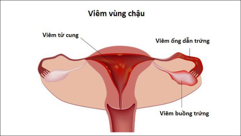 Viêm vùng chậu có thể gây tổn thương ống dẫn trứng dẫn đến vô sinh