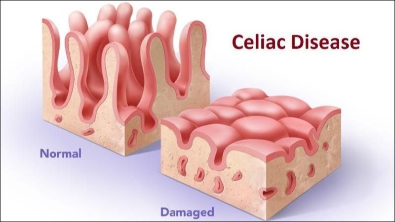 Bệnh Celiac làm phản ứng miễn dịch mạnh mẽ gây teo nhung mao niêm mạc ở ruột non