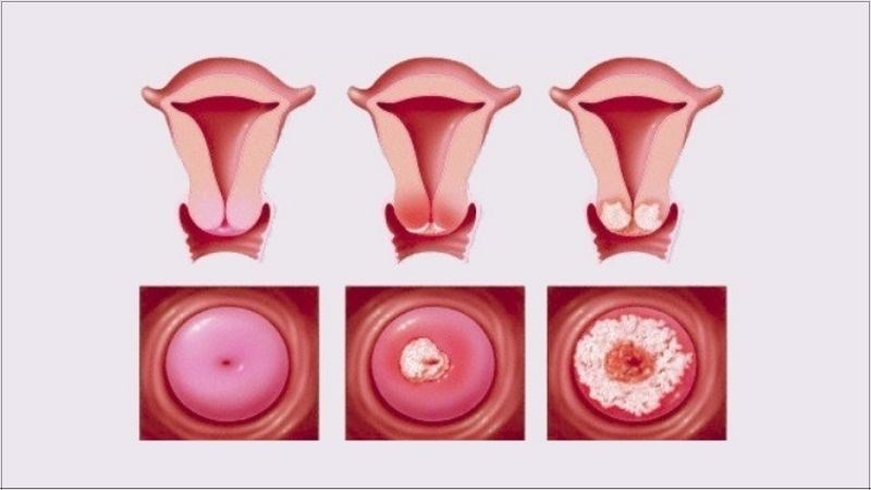 Cổ tử cung có sẹo sẽ làm giảm lượng máu kinh