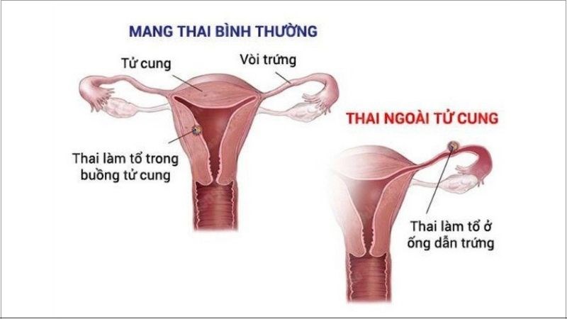 Mang thai ngoài tử cung là nguyên nhân khiến cho kinh nguyệt ra ít hơn bình thường