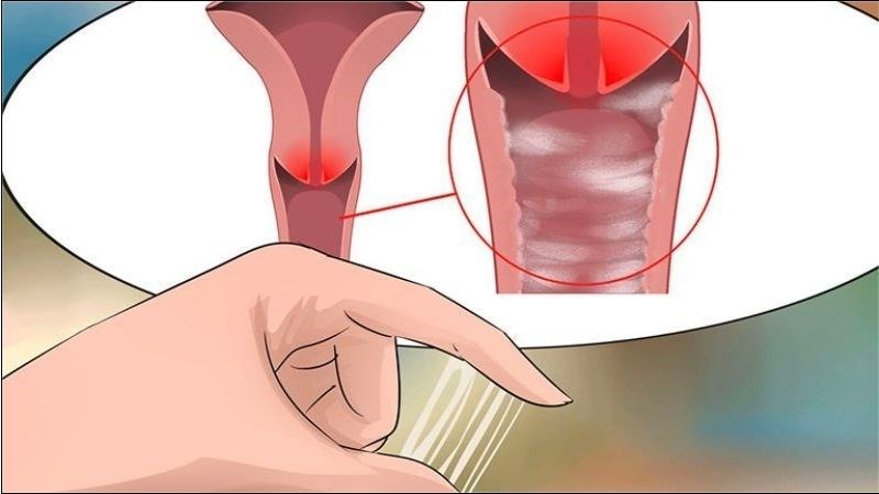 Dịch tiết có thể thay đổi về màu sắc, mùi và độ nhớt khi phụ nữ mắc bệnh lậu