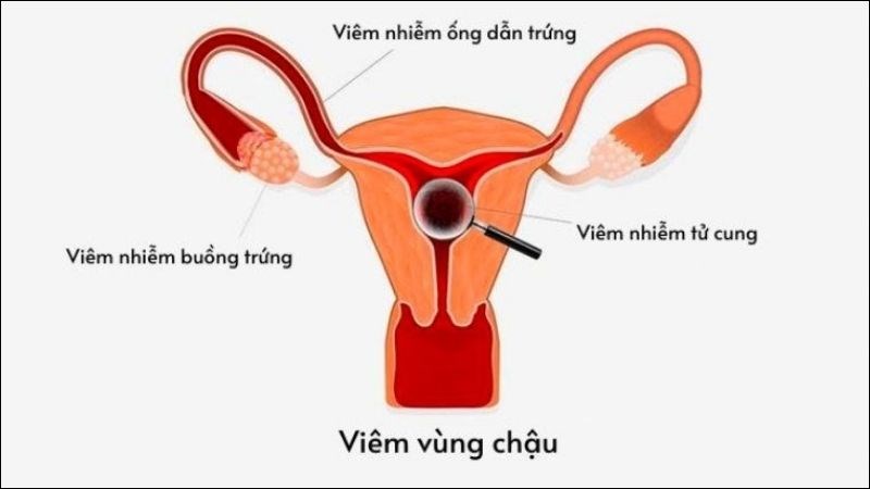Viêm nhiễm vùng chậu có thể dẫn đến mang thai ngoài tử cung và vô sinh