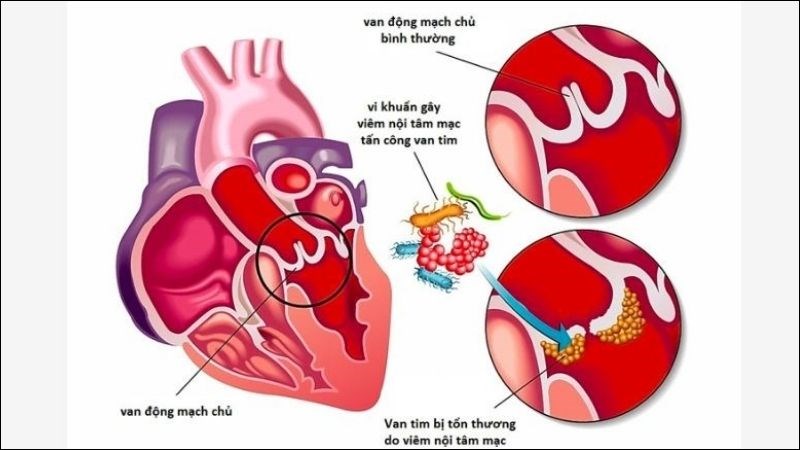 Viêm nội tâm mạc là một triệu chứng hiếm gặp khi nhiễm trùng lậu