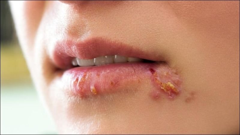 HSV-1 lây truyền qua đường miệng - miệng hay miệng - bộ phận sinh dục