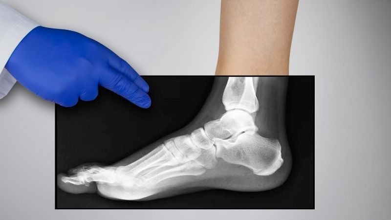 Chụp X-quang l&agrave; x&eacute;t nghiệm được sử dụng nhiều để đ&aacute;nh gi&aacute; t&igrave;nh trạng khớp ng&oacute;n ch&acirc;n