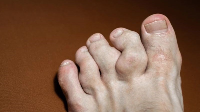 Vi&ecirc;m khớp dạng thấp c&oacute; thể dẫn tới t&igrave;nh trạng vi&ecirc;m v&agrave; thay đổi h&igrave;nh dạng b&agrave;n ch&acirc;n