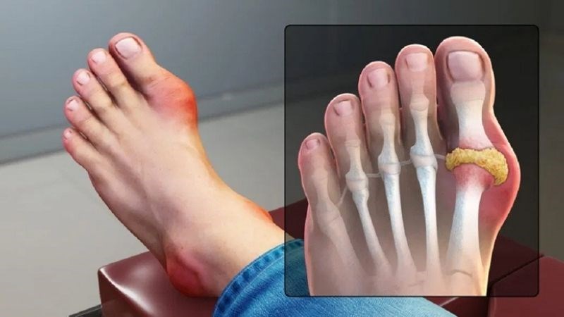 Gout l&agrave; bệnh l&yacute; xảy ra do sự lắng đọng v&agrave; t&iacute;ch tụ axit uric