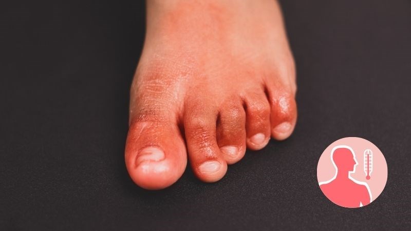 Khi xuất hiện sưng, đau ng&oacute;n ch&acirc;n k&egrave;m sốt, người bệnh n&ecirc;n đến c&aacute;c cơ sở y tế để được điều trị