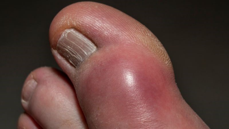 Người mắc bệnh gout không nên ăn khoai sọ