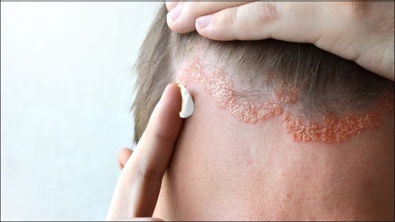 Dùng thuốc bôi có thể giúp kiểm soát triệu chứng của bệnh vảy nến