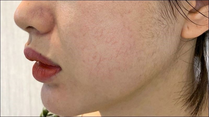 Retinol và vitamin C chỉ gây mỏng da nếu dùng tần suất lớn