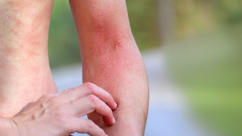 Có thể trị viêm da, ngứa lở bằng hoàng bá và thạch cao