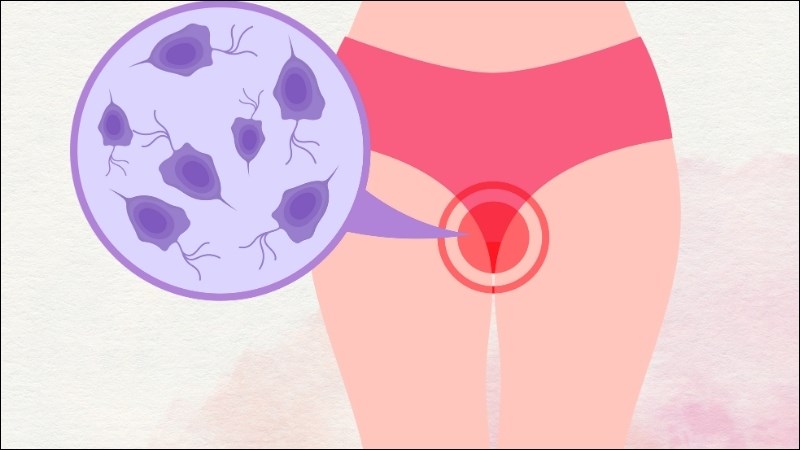 Có nhiều bài thuốc về hoàng bá giúp trị viêm ngứa âm đạo do trùng roi