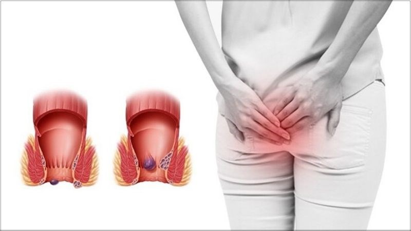 Tô mộc giúp hỗ trợ điều trị bệnh trĩ mới mắc