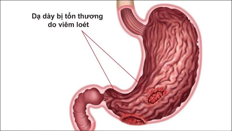 Tinh dầu quế giúp làm lành các vết loét, đặc biệt là vết loét ở dạ dày