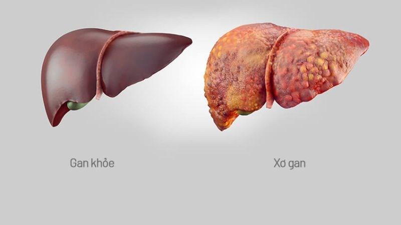 Xơ gan là tình trạng gan bị tổn thương bởi các tác nhân gây hại