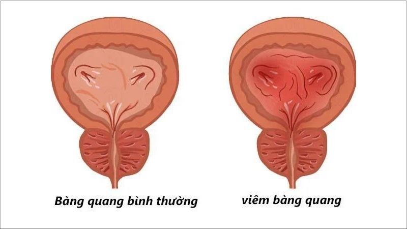 Râu mèo hỗ trợ điều trị bệnh viêm bàng quang 