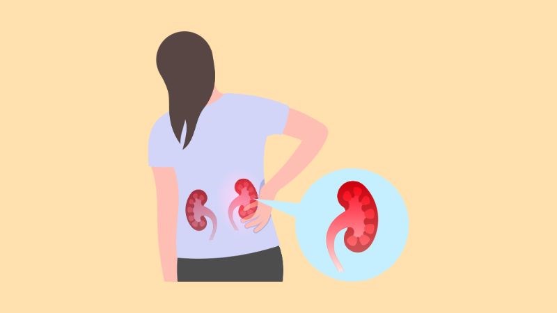 Viêm cầu thận là tình trạng viêm nhiễm xảy ra tại các cầu thận