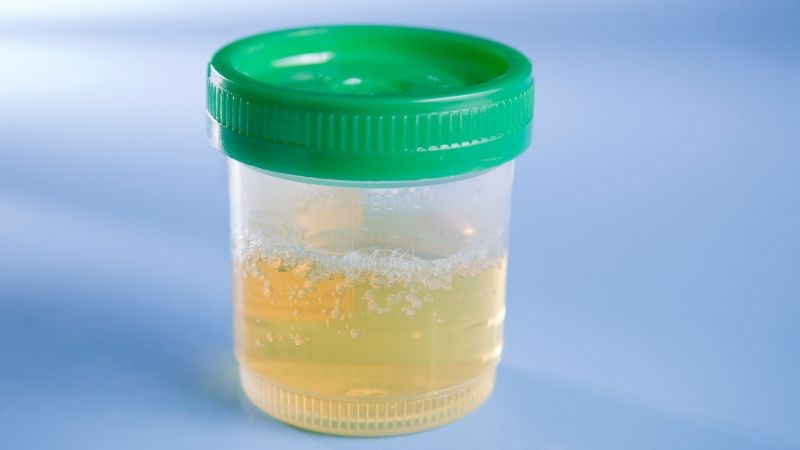 Nước tiểu có bọt là một trong các triệu chứng điển hình của viêm cầu thận