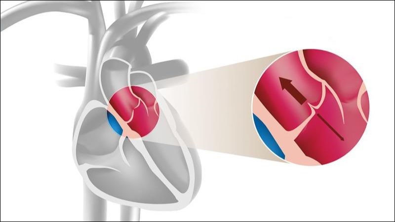 Suy tim có thể gây ra hỏng van tim Suy tim có thể gây ra hỏng van tim