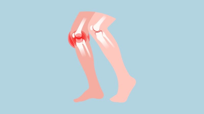 Tràn dịch khớp gối là tình trạng lượng dịch khớp gối tăng bất thường