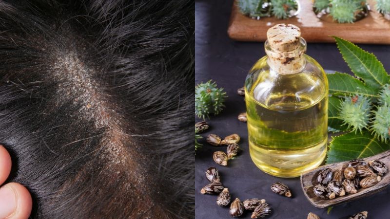 Dầu thầu dầu chứa hàm lượng axit ricinoleic cao là chất có đặc tính chống nấm mạnh