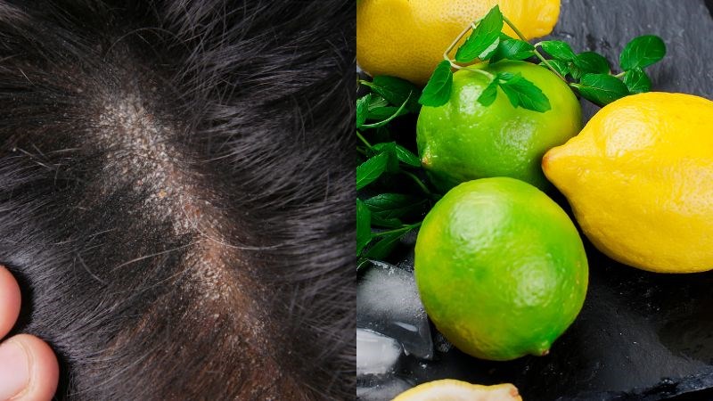 Các hoạt chất vitamin C, flavonoid trong chanh có đặc tính kháng khuẩn, chống viêm, giúp tiêu diệt nấm