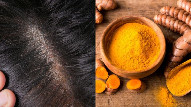 Nghệ giảm bớt các triệu chứng khó chịu do nấm tóc