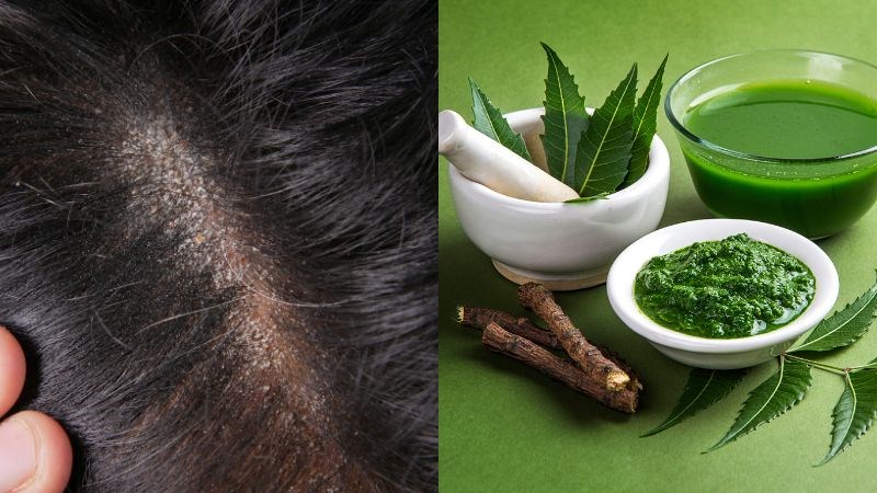 Lá neem có đặc tính kháng khuẩn và kháng nấm mạnh
