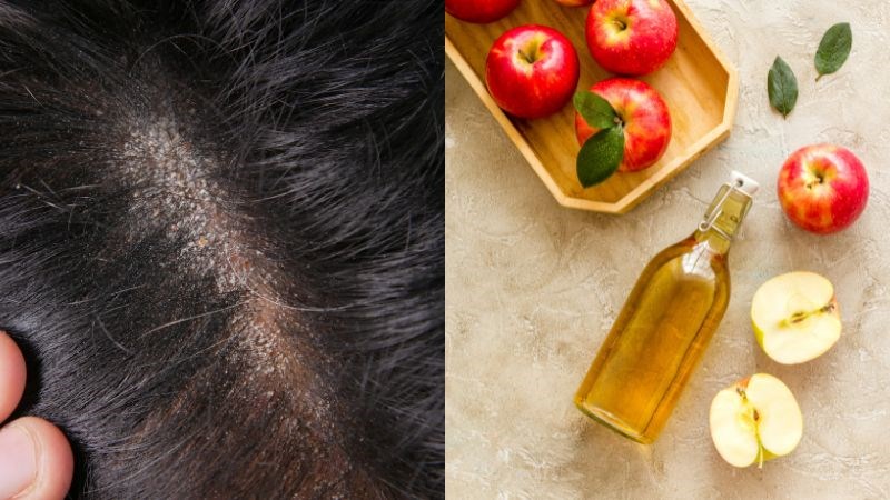Giấm táo có đặc tính kháng nấm tự nhiên