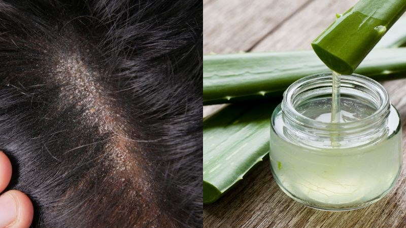 Thành phần aloin trong gel lô hội có đặc tính chống viêm