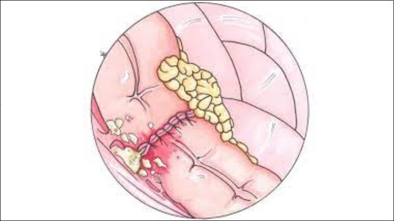 Rò rỉ miệng nối là một biến chứng nghiêm trọng sau phẫu thuật cắt dạ dày