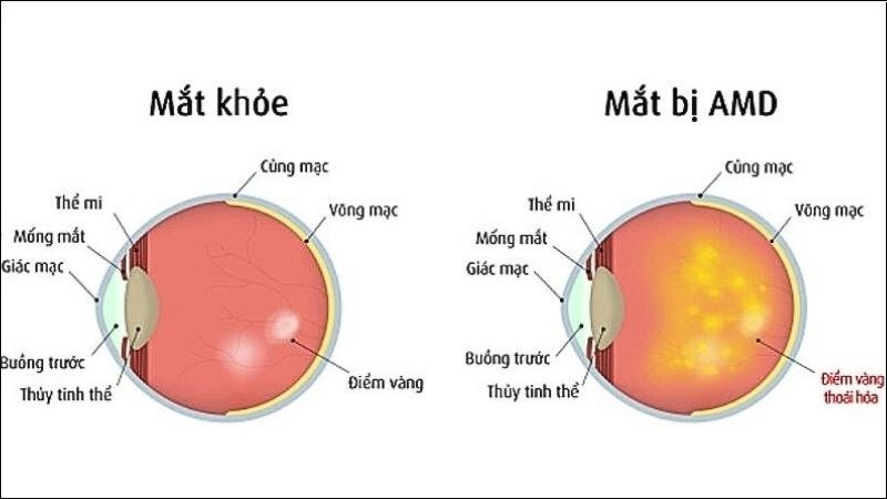 Vitamin A khi kết hợp với các vitamin làm giảm nguy cơ mất thị lực do thoái hóa điểm vàng Vitamin A khi kết hợp với các vitamin làm giảm nguy cơ mất thị lực do thoái hóa điểm vàng