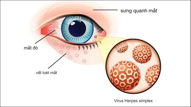 Herpes gây vết thương đau và sưng trên mí mắt Herpes gây vết thương đau và sưng trên mí mắt