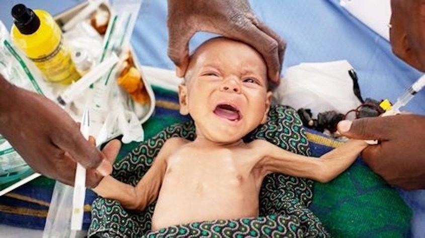 Hậu quả khôn lường khi trẻ suy dinh dưỡng thấp còi kéo dài 