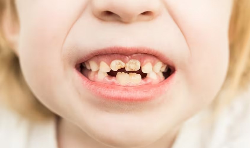 Nguyên nhân gây sâu răng ở trẻ nhỏ