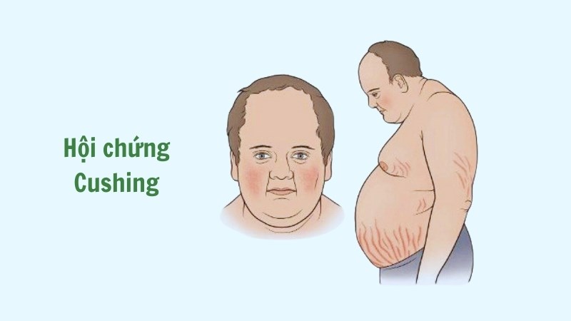 Hội chứng Cushing làm tăng nguy cơ mắc bệnh đái tháo đường