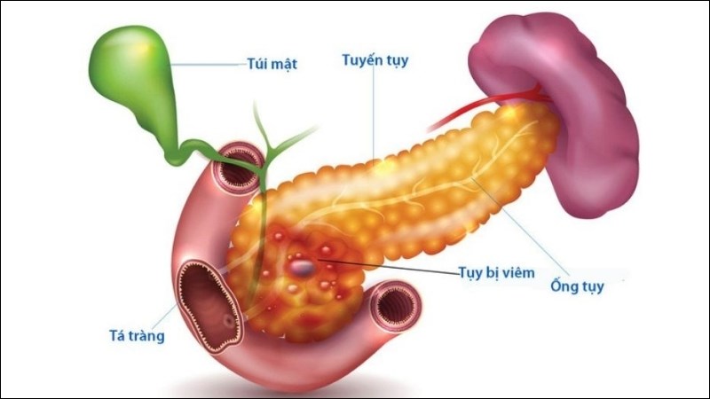 Viêm tụy có thể gây hại cho các tế bào beta và dẫn tới suy giảm khả năng tạo insulin