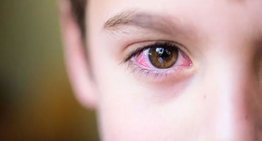 Đau mắt đỏ thường xuất hiện khi thời tiết thay đổi