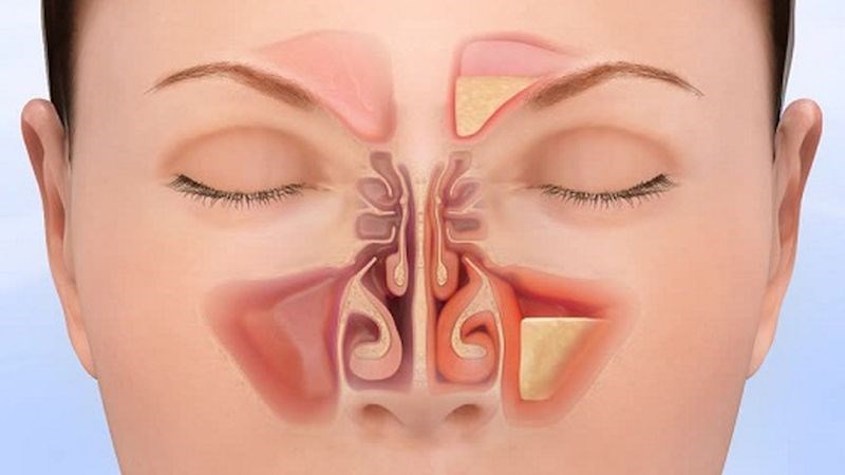 Viêm xoang thường gây đau nhức khó chịu khi thời tiết thay đổi