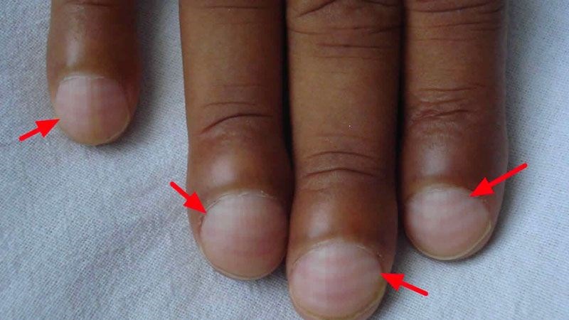 Xơ cứng đường mật nguyên phát làm xuất hiện ngón tay dùi trống