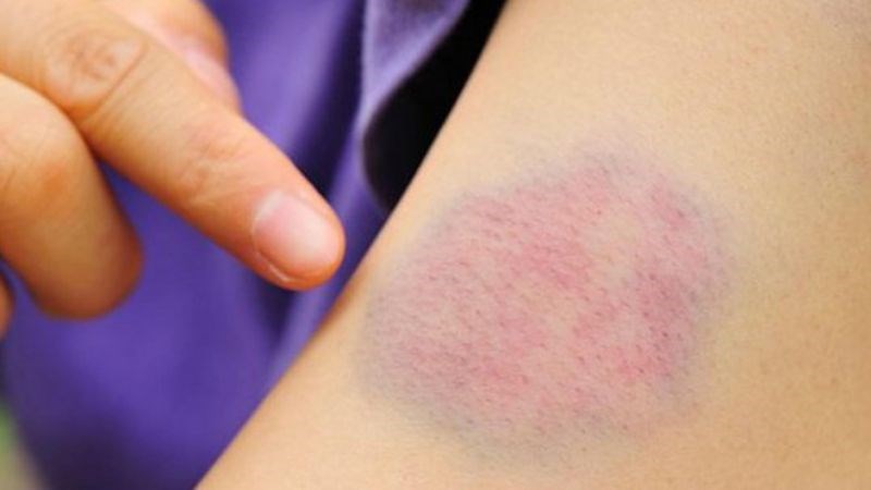 Người mắc bệnh gan dễ xuất hiện vết bầm tím trên da