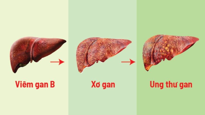 Một số bệnh về gan thường gặp có thể liên quan đến nhau