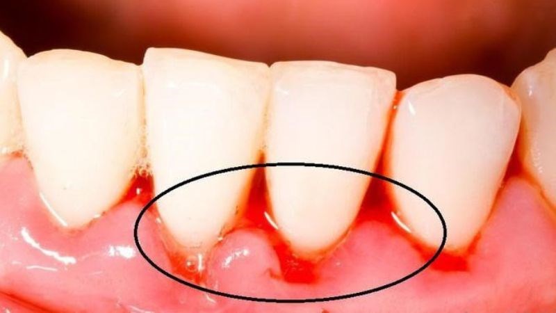 Bệnh về gan có thể gây chảy máu chân răng